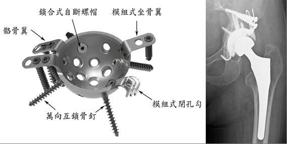 模組化多軸互鎖式髖臼強化器結構及植入髖臼後之X光影像