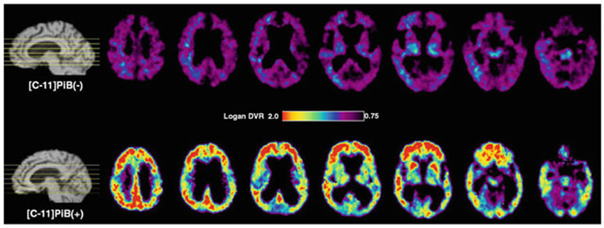 11C-PIB於正常受試者(上排)及罹患阿茲海默氏症病患(下排)腦部正子斷層造影影像